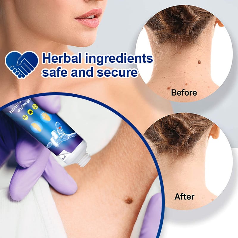 Aurece – WartClear Herbal Removal Cream Dermacure Pro