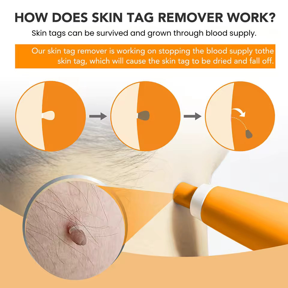 2 IN 1 Auto Micro Skin Tag Remover Device Standard And Micro Skin Tag Removal Kit Adult Mole Wart Remover Face Care Beauty Tools