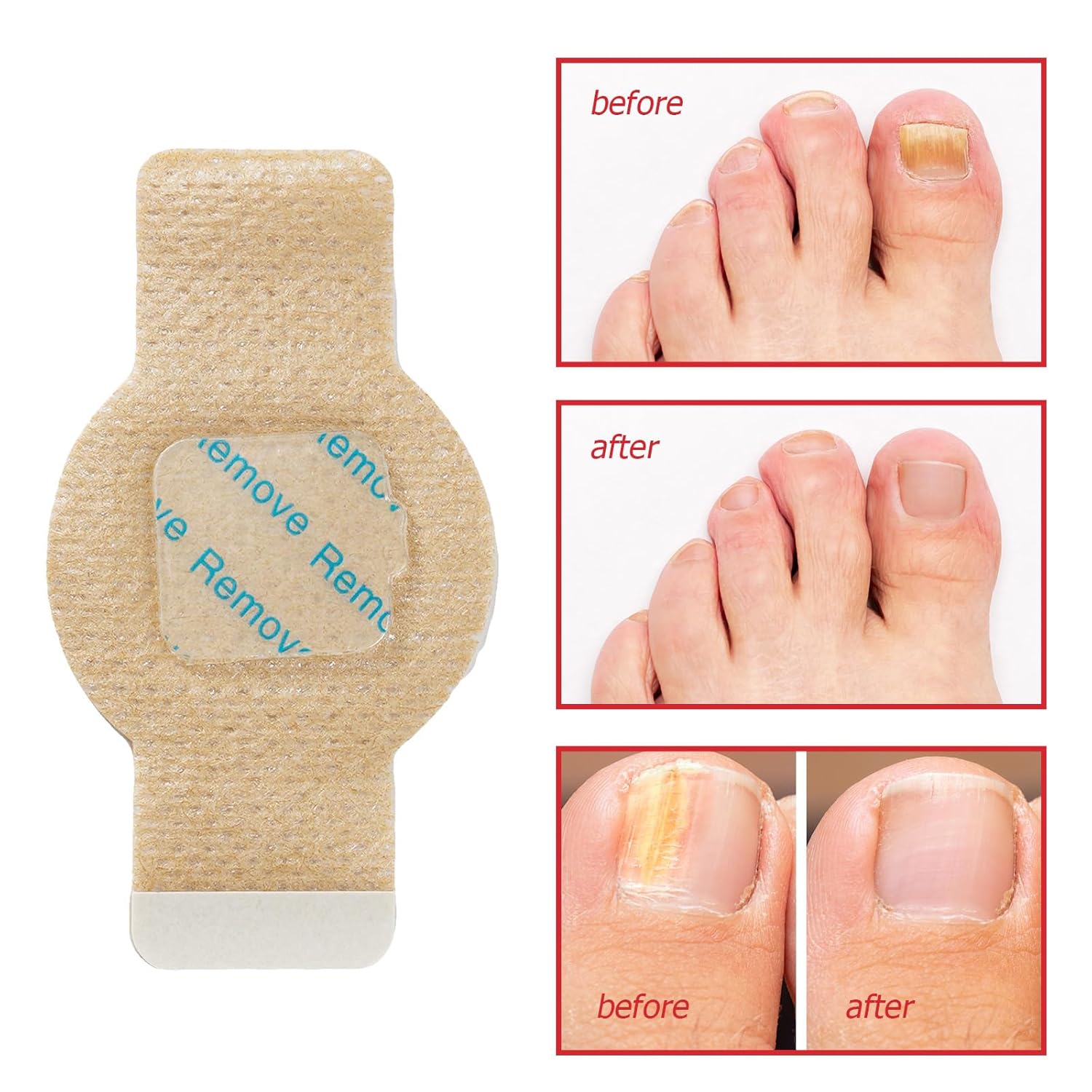Aurece – Fungal Nail Repair Patches | Advanced Toenail Fungus Treatment