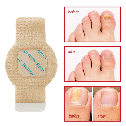 Aurece – Fungal Nail Repair Patches | Advanced Toenail Fungus Treatment
