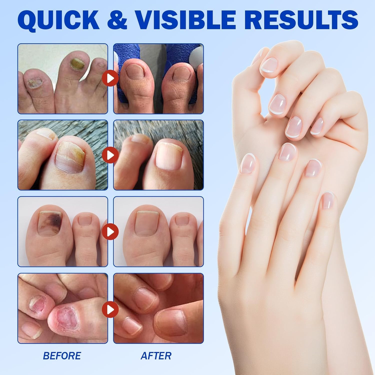 Aurece – Fungal Nail Repair Patches | Advanced Toenail Fungus Treatment
