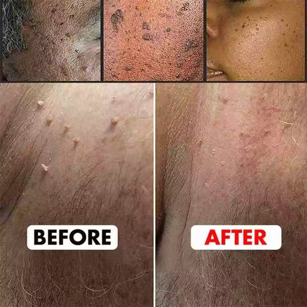 Aurece – WartClear Herbal Removal Cream Dermacure Pro